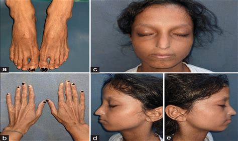 Acrogeria A Rare Congenital Aging Syndrome Indian Journal Of
