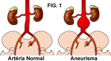 Se um aneurisma se formar na aorta abdominal e ficar muito grande, a aorta poderá se rasgar ou explodir. Aprenda Um Pouco Mais Sobre o Aneurisma | Saúde - Cultura Mix
