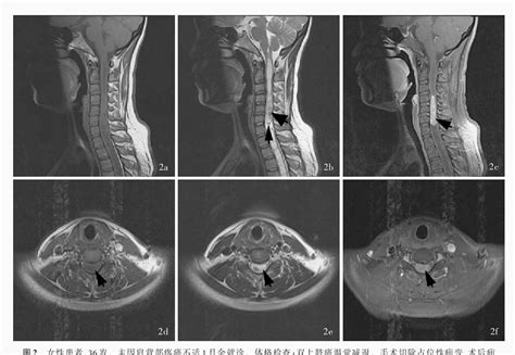 Figure 2 From Differential Diagnosis Of Cervical Spinal Cord Demyelinating Diseases And Cervical