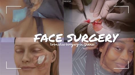 Cosmetic Face Surgery In Ghana Sebaceous Cyst Removal Youtube