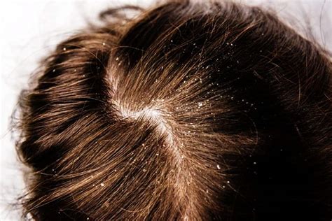 How To Get Rid Of Dandruff Shahnaz Husain Shares Useful Tips To Get