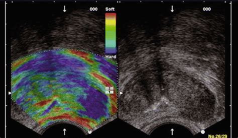 Urologic Ultrasound Protocols Radiology Key