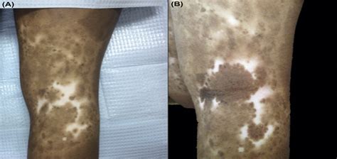 Use Of Epidermal Grafting For Treatment Of Depigmented Skin