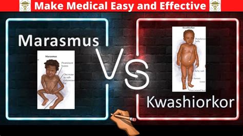 Difference Between Marasmus And Kwashiorkor Shorts Mbbs Neetpg