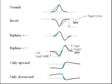 T Wave Morphologies A Signal Preprocessing Lowpass And Highpass