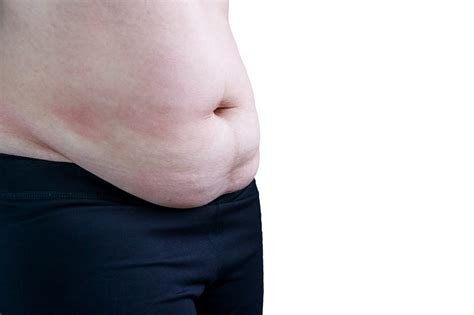 Does your health insurance cover plastic surgery? Panniculectomy Surgery | Post-Bariatric Body Contouring