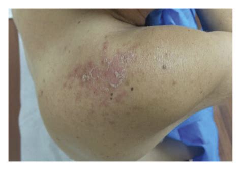 Well Demarcated Pink Papules And Plaques With Fine Scale Present On