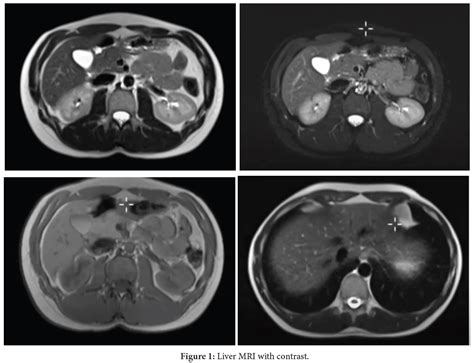 Liver Mri With Contrast A Comprehensive Guide To The Procedure And