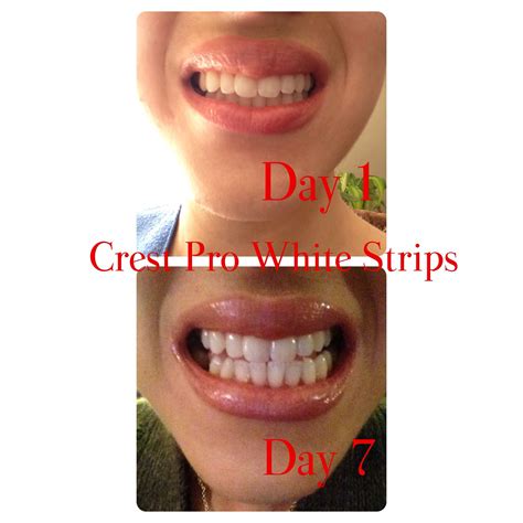 My Crest White Strips Results Crest White Strips Dental Hygienist Lipsense Dentist Floss