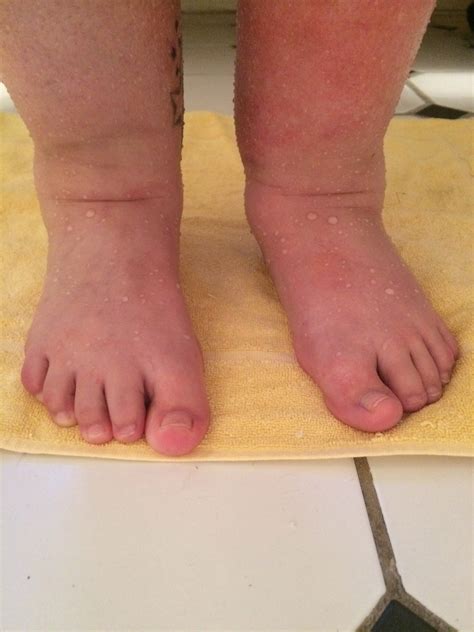 Swelling Feet And Legs — The Bump