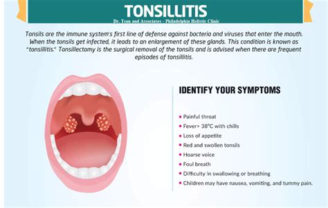 Treatment Of Tonsillitis Philadelphia Holistic Clinic Dr Tsan