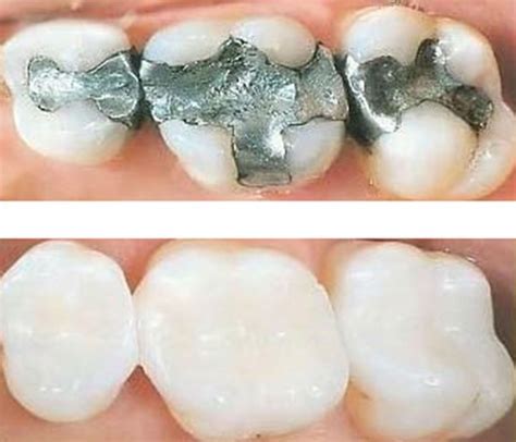 Cinco Beneficios De Las Resinas Dentales Odontotecks