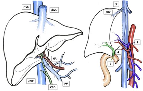 Imaging Post Liver Transplantation Part I Vascular Complications