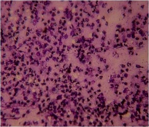 Cytology Of Pleural Fluid Showing Sheet Of Degenerative Neutrophils