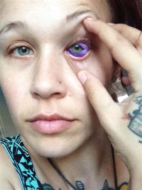 Canadian Woman Could Go Blind After Getting Eyeball Tattooed Photos