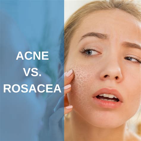 Acne Vs Rosacea Whats The Difference