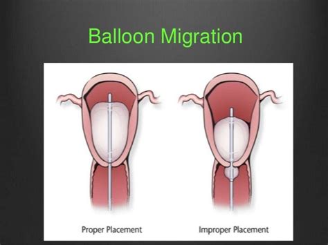 Uterine Balloon Tamponade In Postpartum Hemorrhage Pph