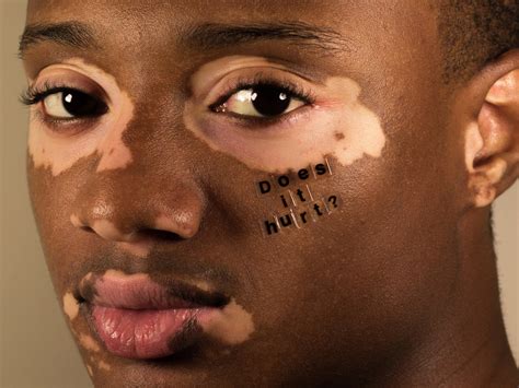 This Photographer Is Documenting The Realities Of Living With Skin