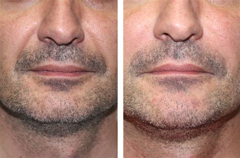 Dermal Fillers Juvederm® Facial Cosmetic Surgery Dr Antipov