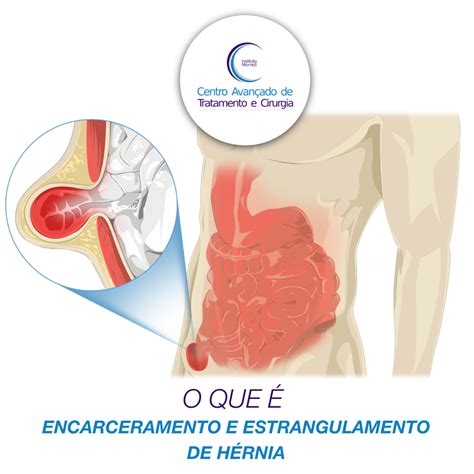 saiba o que é encarceramento e estrangulamento de hérnia instituto morrell