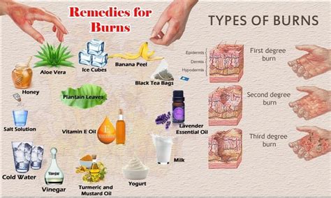 Natural Healing Cavities Home Remedies For Burns Second Degree Burn