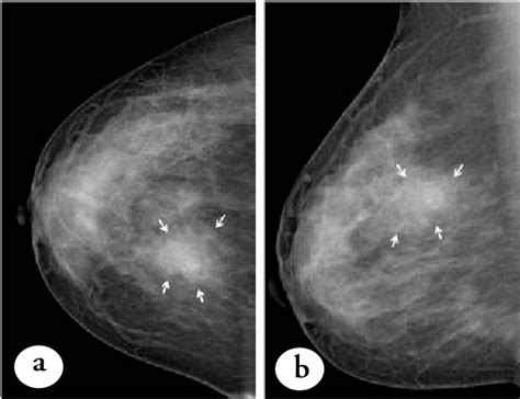 Figure 1 From Bilateral Intraductal Papillomas Arising In Ectopic