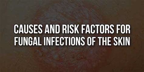 Causes And Risk Factors For Fungal Infections Of The Skin Exeideas