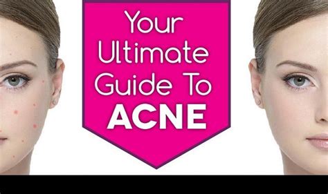 Your Ultimate Guide To Acne Infographic Visualistan