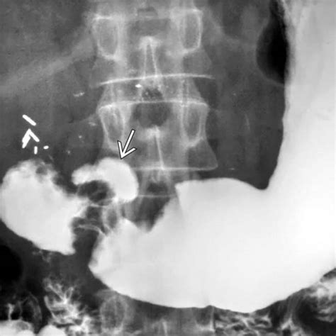 Gastric Ulcer Radiology Key