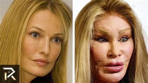 Worst Cases Of Plastic Surgery Obsession With Images Plastic