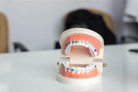 Affordable Braces Dubai Dental Braces And Teeth Aligners Top Smile