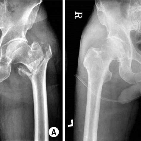 Pdf Fixation Of The Greater Trochanter In Arthroplasty For Unstable