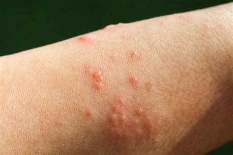 How To Handle Poison Ivy Blisters