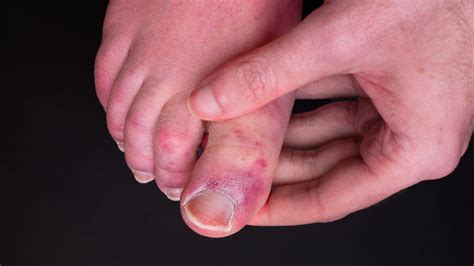 We Might Finally Know What Causes Covid Toes Live Science