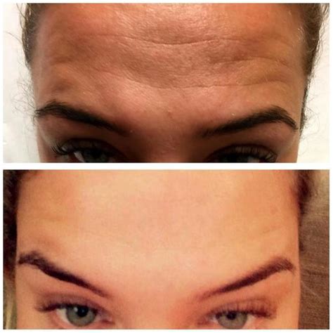 Botox Before After Pictures Forehead Wrinkles 2 Facial Injections