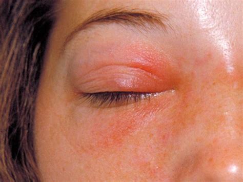 What Causes Rashes On Eyelids Makeupview Co