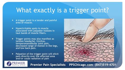 Trigger Point Therapy At A Top Chicago Pain Management Center 847 519