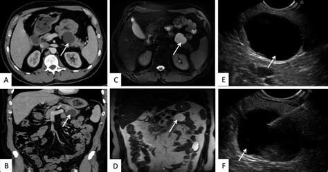 Pancreatic Body Cysts As Detected By Ct Ab Mri Cd Eus E And