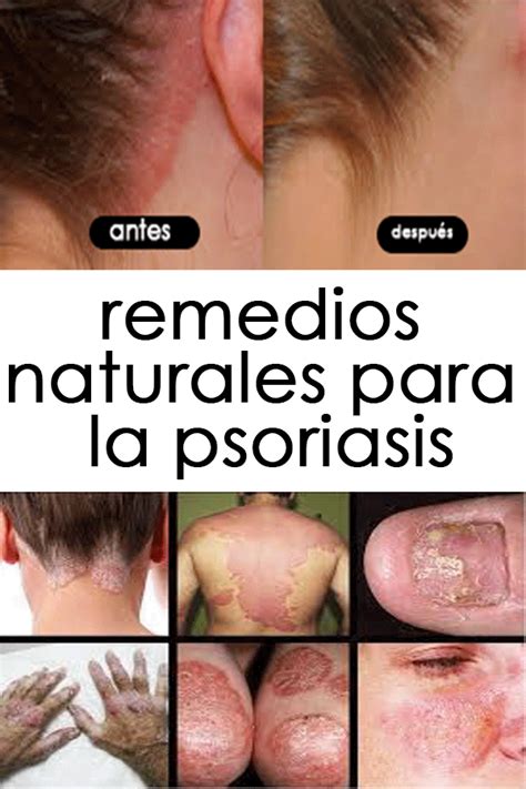 Remedios Naturales Para La Psoriasis Salud Caseros Remdios Recetas