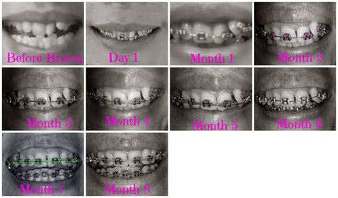 Adult Braces My Journey 8th Month In Top Braces 2nd Month In Bottom Braces