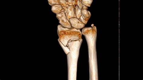 Distal Ulna Fracture Causes Diagnosis Treatment Rxharun
