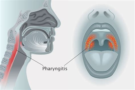 How To Manage Pharyngitis At Home Emedihealth