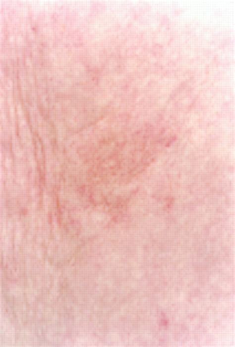 Purpuric Rash With Donepezil Treatment The Bmj