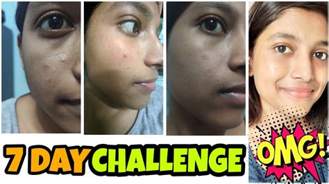 Remove Dark Spots Naturally At Home In 7 Days ️ 7 Days Transformation