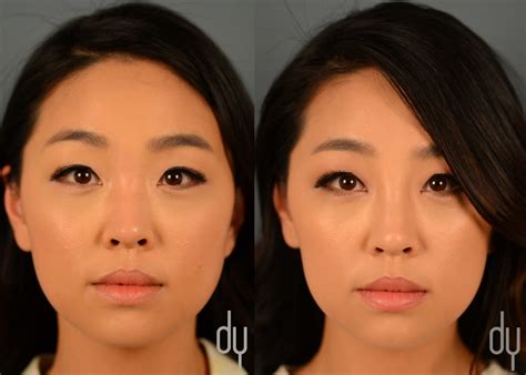 Before And After Nonsurgical Rhinoplasty Nonsurgical Nose Job Dorsal