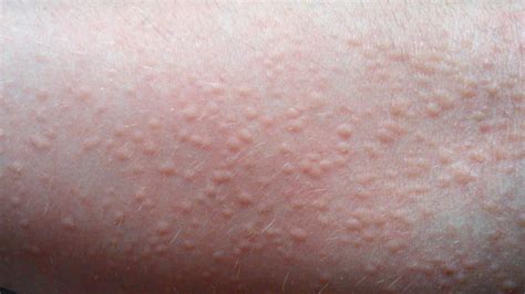You may have itchy skin over certain small areas, such as on an arm or leg, or over your whole body. Hives: Causes, Risks, Prevention, and Pictures