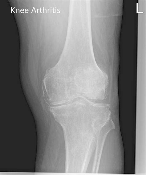 Xray Knee Osteoarthritis