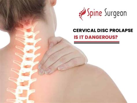 Cervical Disc Prolapse Is It Dangerous Spine Surgeon Hot Sex Picture