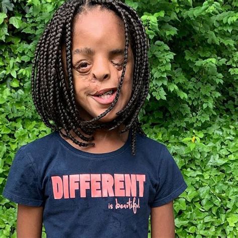 11 Year Old Girl Teaches Valuable Lesson About Embracing What Makes Your Different Good