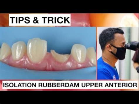 Tips And Trick Isolation With Split Dam Upper Anterior Without Clamp